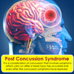 post-concussion-syndrome
